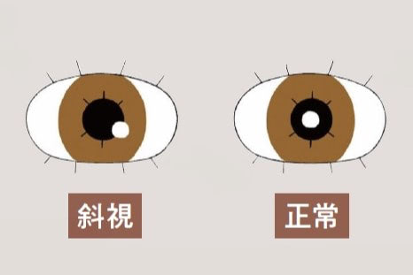 斜視　図
