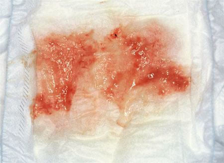 腸重積1