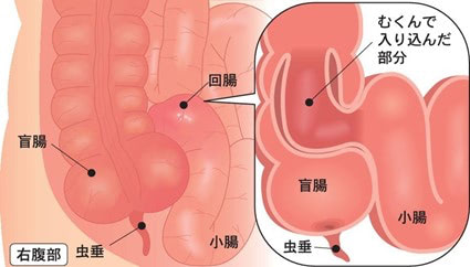 腸重積症　図解