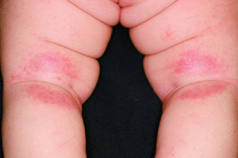 ひざ裏にできたアトピー性皮膚炎。足首、手首などのくびれ部分、皮膚がこすれる部分に出やすい。