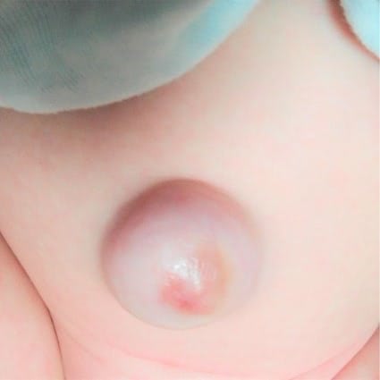 臍ヘルニア　写真