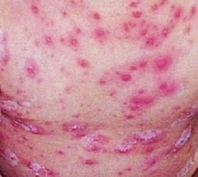 発熱と同時に出る直径1～3mmの発疹は、やがて白くにごった液が入った膿疱になり、その後かさぶたに