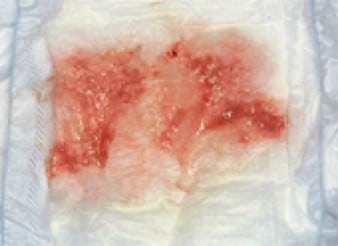 腸重積症　血便