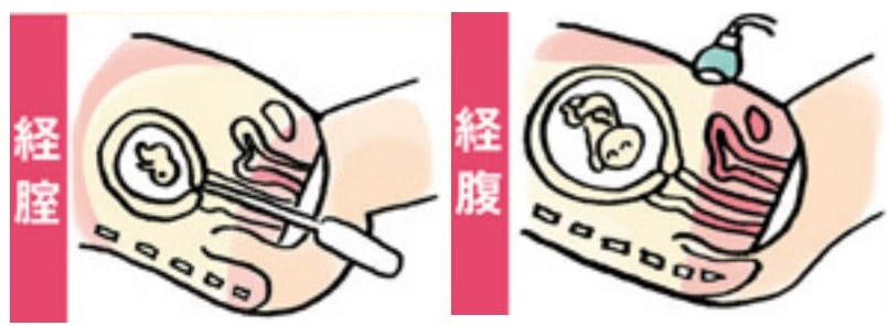 経腟