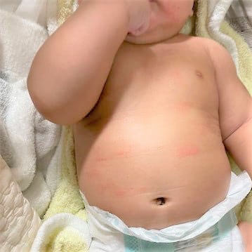 赤ちゃん　コロナ　湿疹