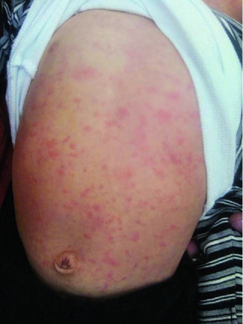 突発性発疹 生後6ヶ月～1歳ぐらいにかかりやすい病気です。特に症状がなく、39度ぐらいの高い熱が3～4日続き、その後熱が下がると同時におなかを中心に細かく赤い発疹が出て、全身に広がります。発疹にはあまりかゆみはありません。  原因はヒトヘルペスウイルス6型と7型の2種類。そのため、一度かかってもまたかかることもあります。特に流行する季節はなく、一年中見られます。