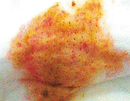 腸重積2