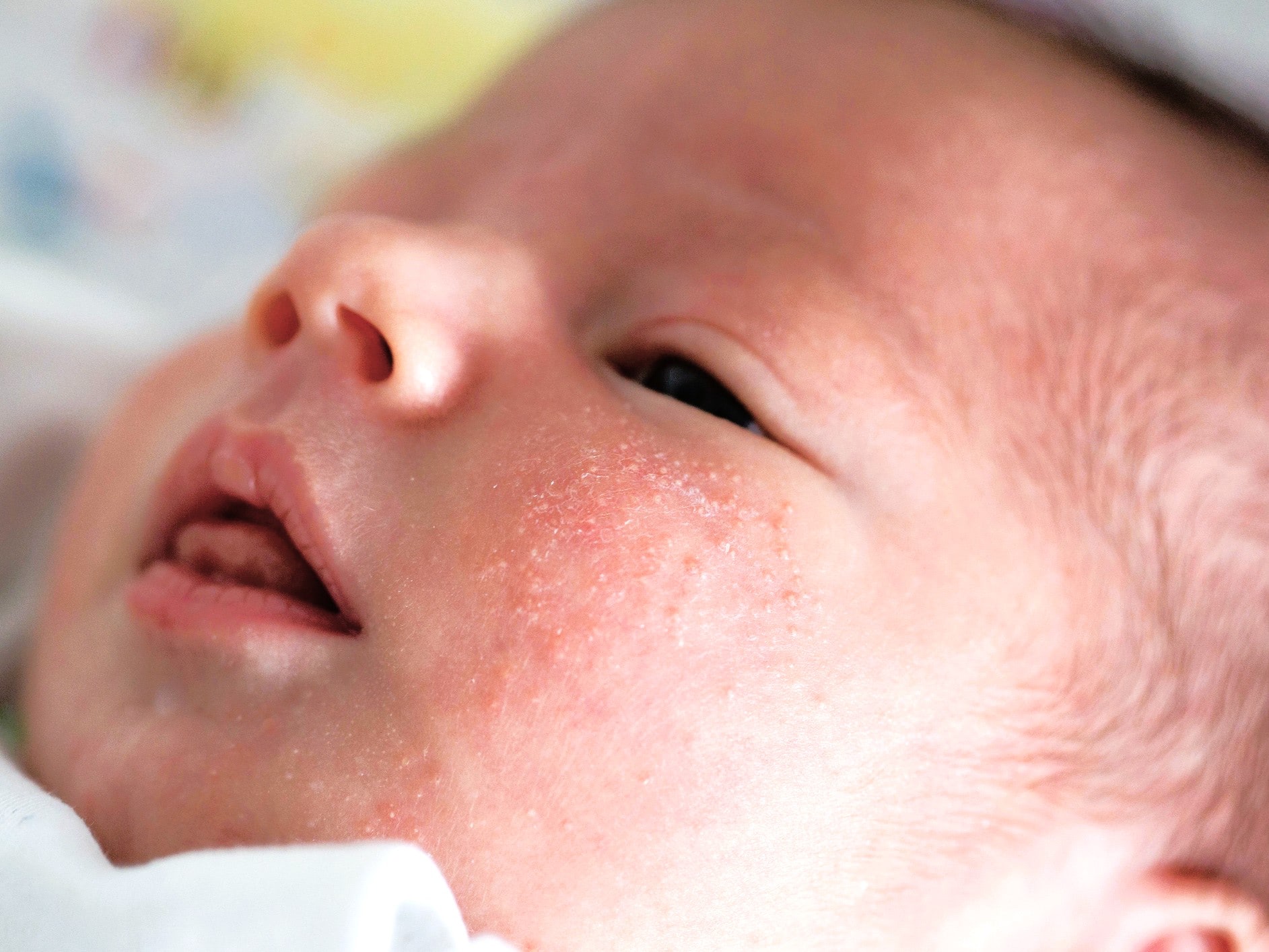 【医師監修】赤ちゃんの顔や頭にブツブツが！？新生児に多い「乳児湿疹」（脂漏性皮膚炎）の原因・予防・対処法
