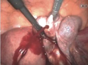 卵管留血腫 血液がたまる
