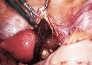 卵管留膿腫 膿みがたまる