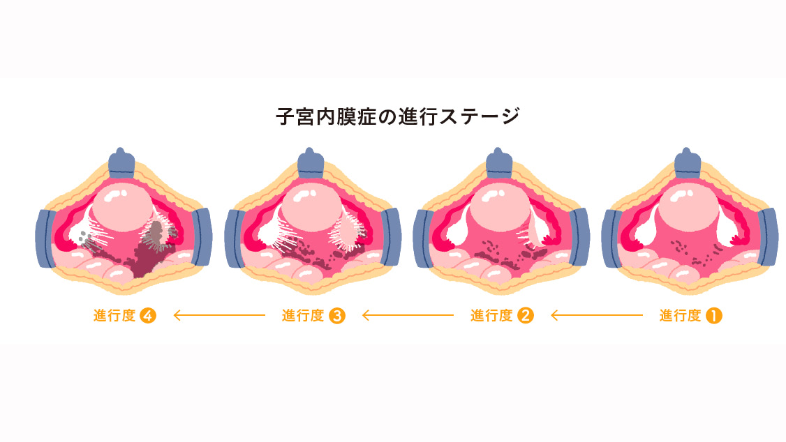 【名医に聞く】子宮内膜症・子宮筋腫があっても妊娠できる？婦人科２大疾患がある場合の不妊治療の最適解。体験談も