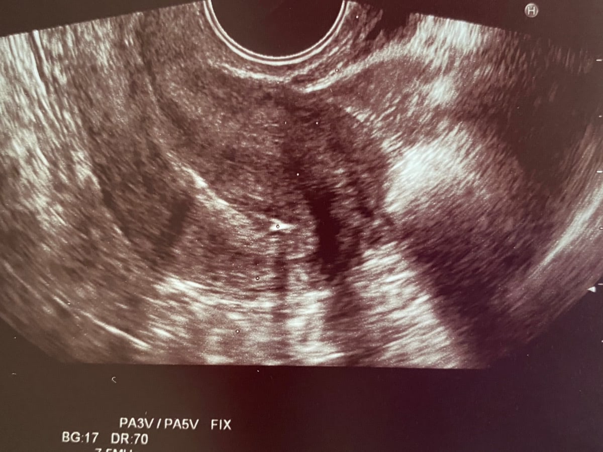 【顕微授精で妊娠しました】悩んだステップアップのタイミング…３つの決め手。「体外受精」との違いに感じた不安は？