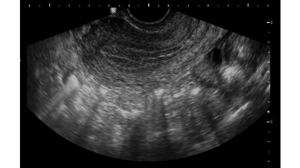 子宮内膜が薄くて治療が進められない。内膜を厚くする方法なんてあるのでしょうか？【ドクターに教えてほしい】