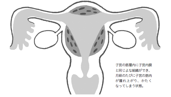 イラスト図解）子宮腺筋症