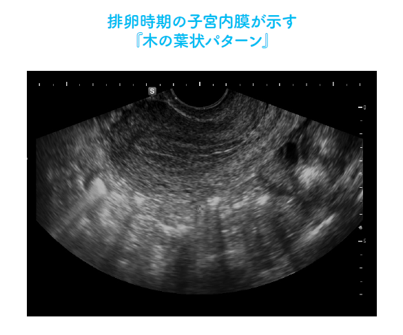 排卵時期の子宮内膜が示す「木の葉状のパターン」