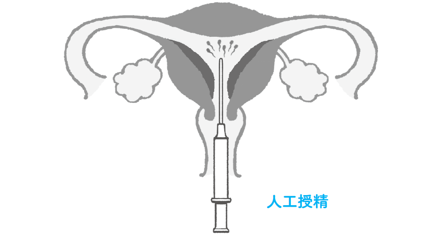人工授精での妊娠率は？不妊治療専門クリニックの人工授精妊娠実績リアルデータもチェック！