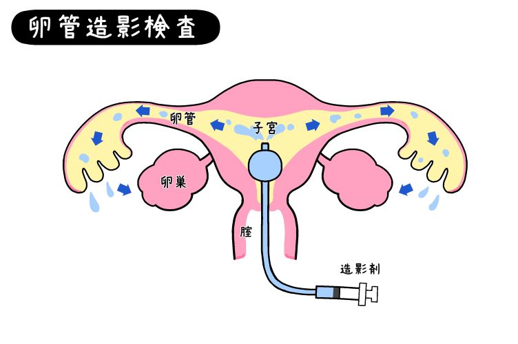 卵管造影検査