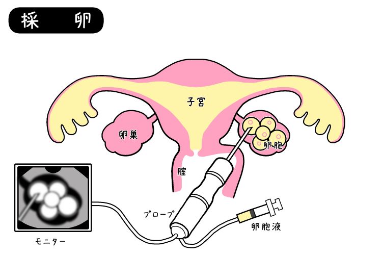 採卵