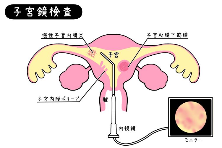 子宮鏡検査
