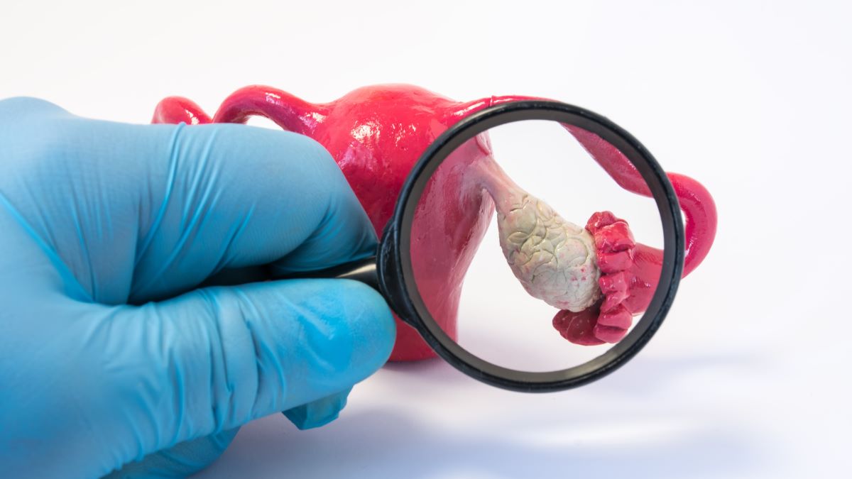 多嚢胞性卵巣症候群（PCOS）です。卵巣刺激によるOHSS（卵巣過剰刺激症候群）のリスクが心配…【教えて！ドクター】