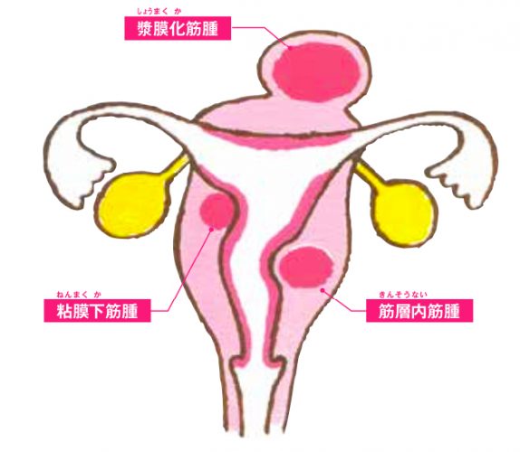 子宮筋腫