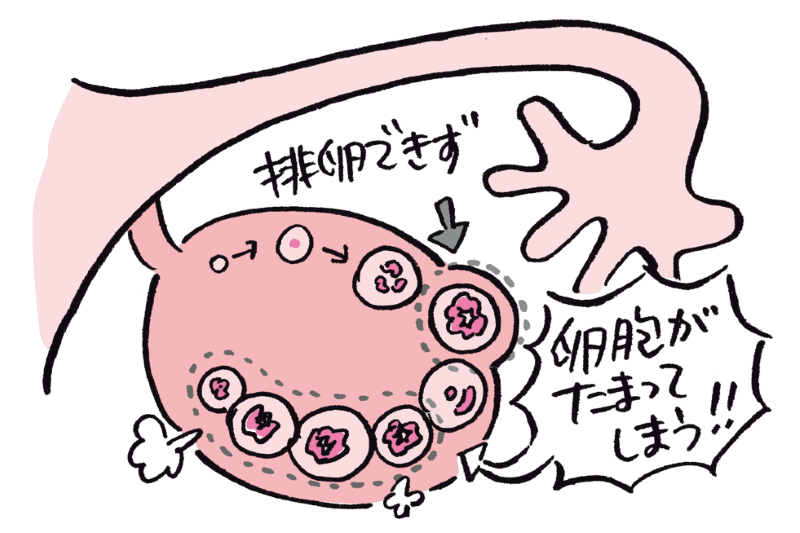 多嚢胞性卵巣症候群の卵巣