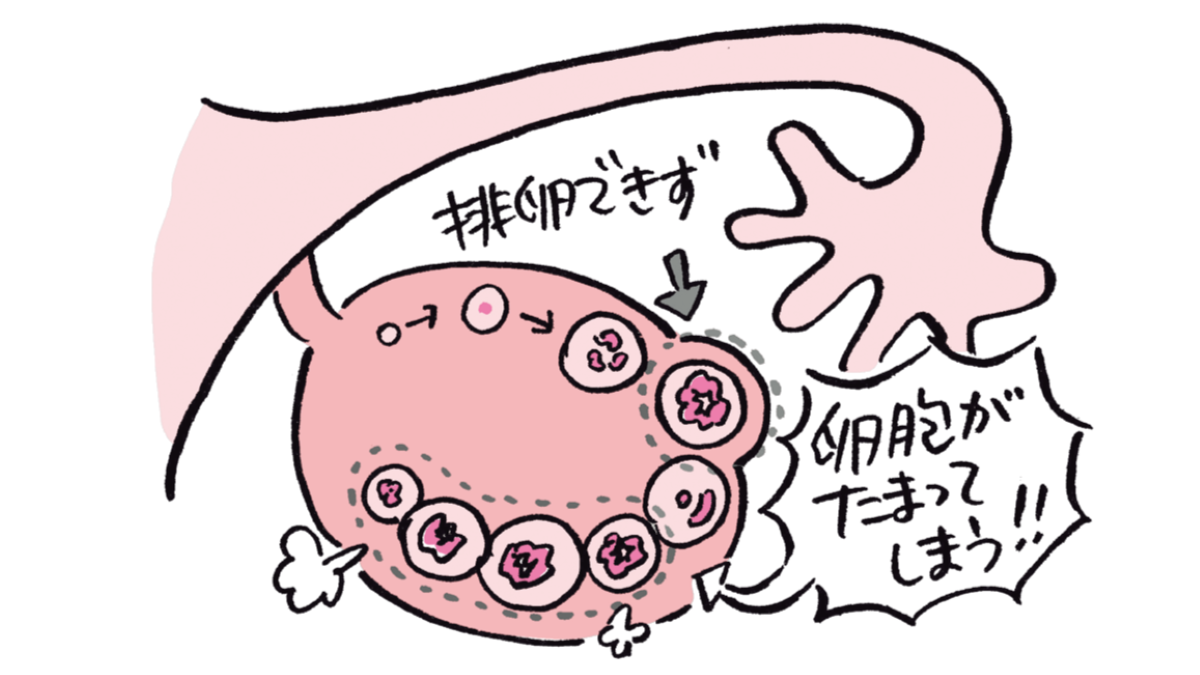 生理不順を放置していたら「多囊胞性卵巣症候群」でした。妊娠に影響はありますか？〈不妊治療専門医アドバイス〉